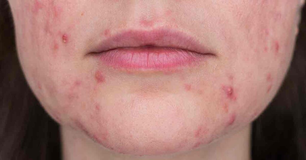 Trądzik różowaty grudkowo-krostkowy na twarzy
