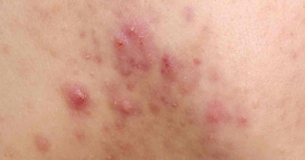 Trądzik różowaty grudkowo-krostkowy