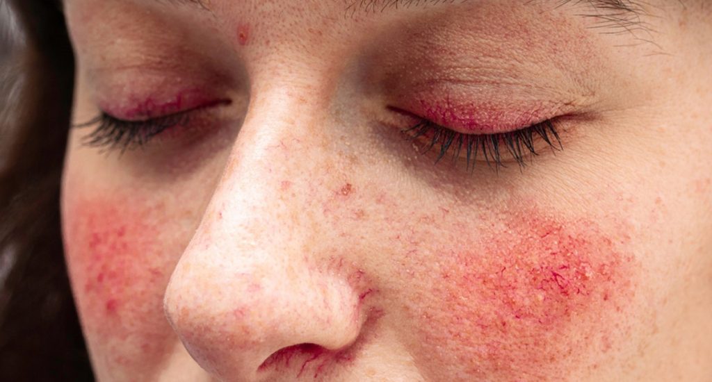 Trądzik różowaty na policzkach i powiekach