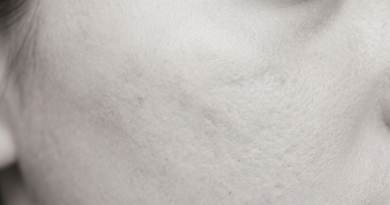 Zbliżenie skóry ze śladami blizn po trądziku w naturalnym oświetleniu